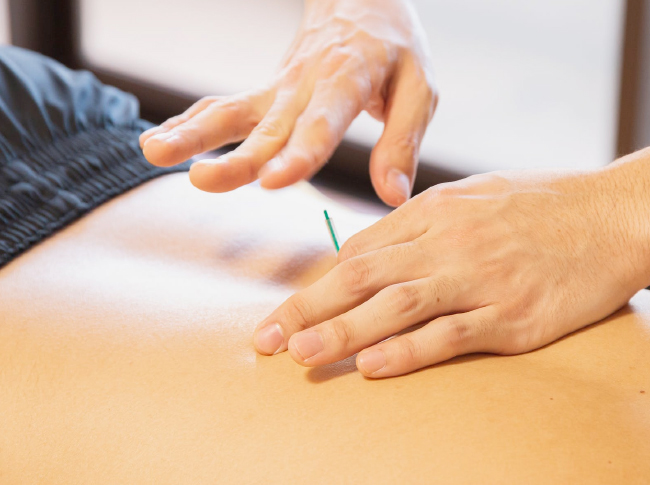 servicios de Acupuntura en Madrid